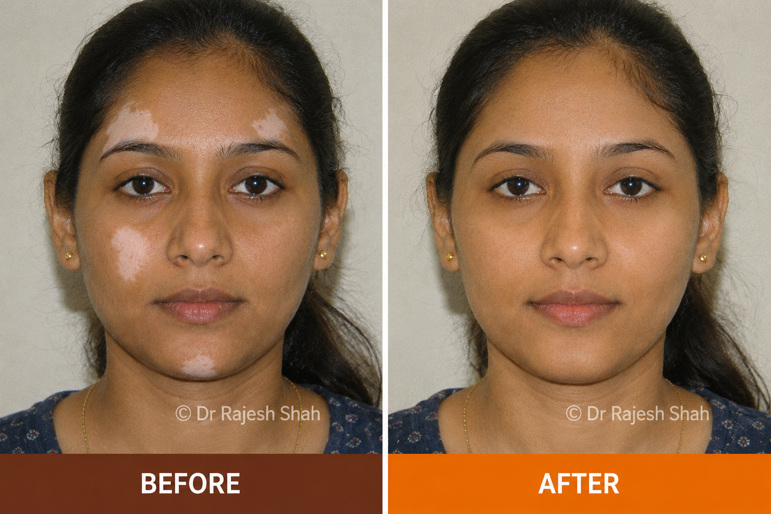 Facial Vitiligo — before and after homeopathic vitiligo treatment
